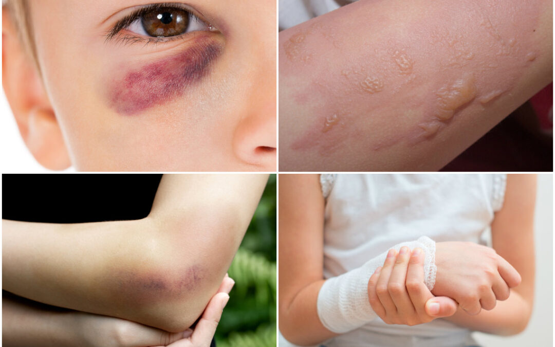 Understanding Non-Accidental Injury: Guidance from Pepperells Solicitors